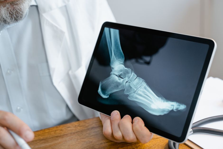 Soft Drinks and Bone Health: What You Need to Know